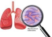 RSUD Taman Husada Ajak Masyarakat Waspadai dan Kenali Gejala TBC Sejak Dini